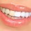 Dantų laminatės – greitas būdas atrodyti nepriekaištingai