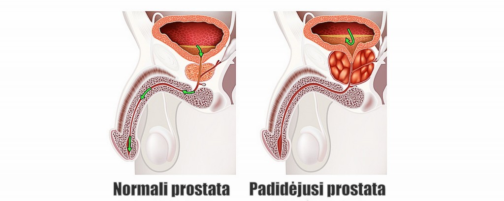 prostatos masažuoklis padeda nuo prostatos ligų