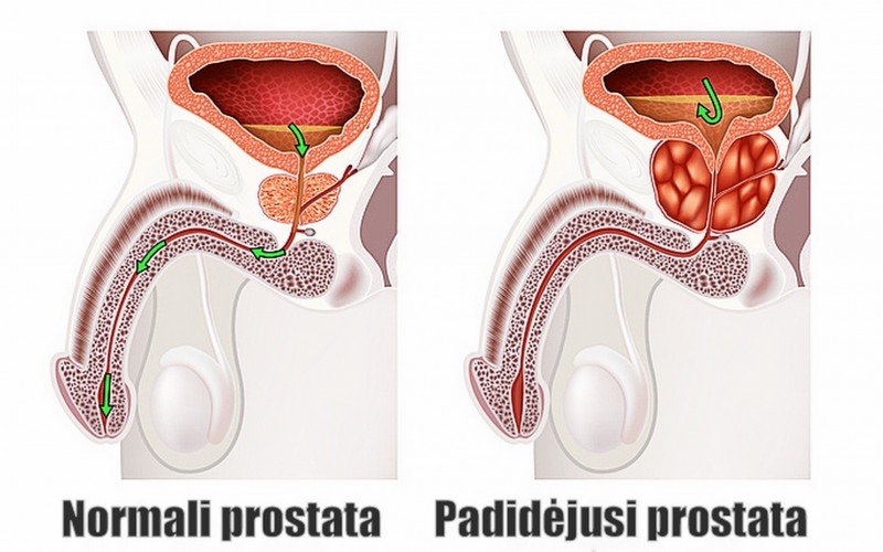prostatos masažuoklis padeda nuo prostatos ligų