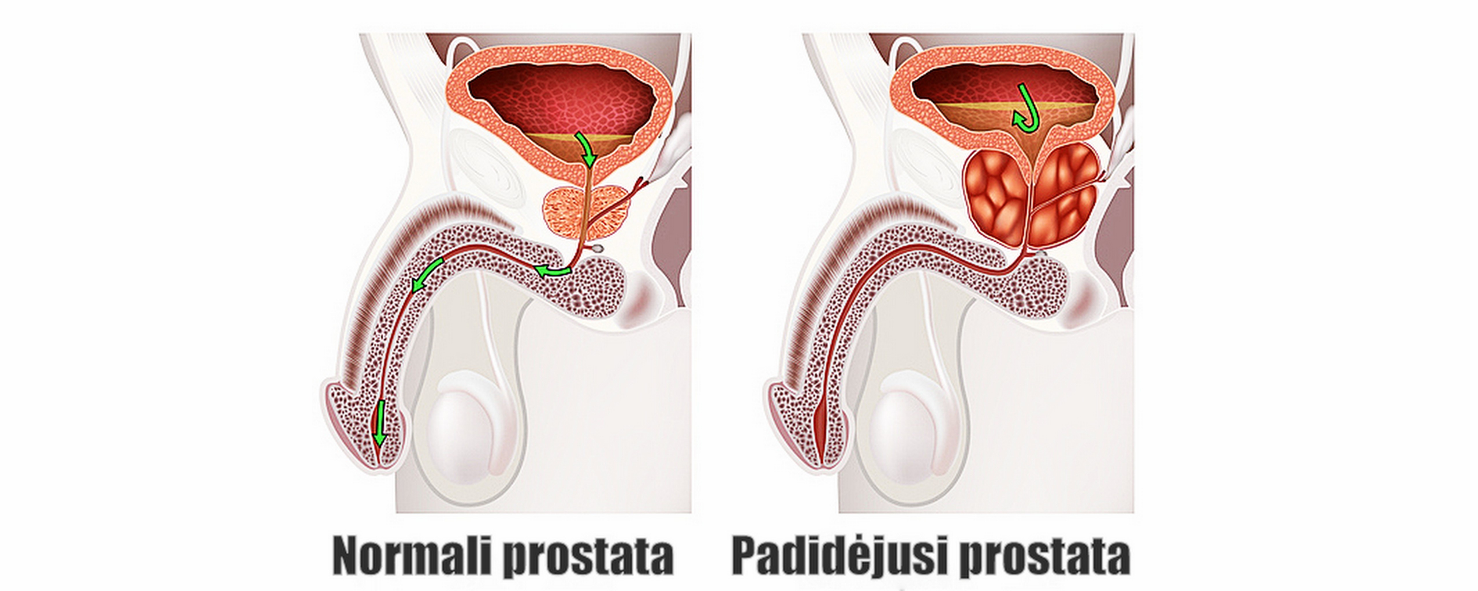 prostatos masažas erekcijos metu)