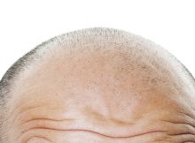 Plaukų slinkimo priežastys vyrams