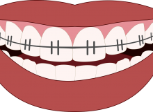 ortodontinis gydymas