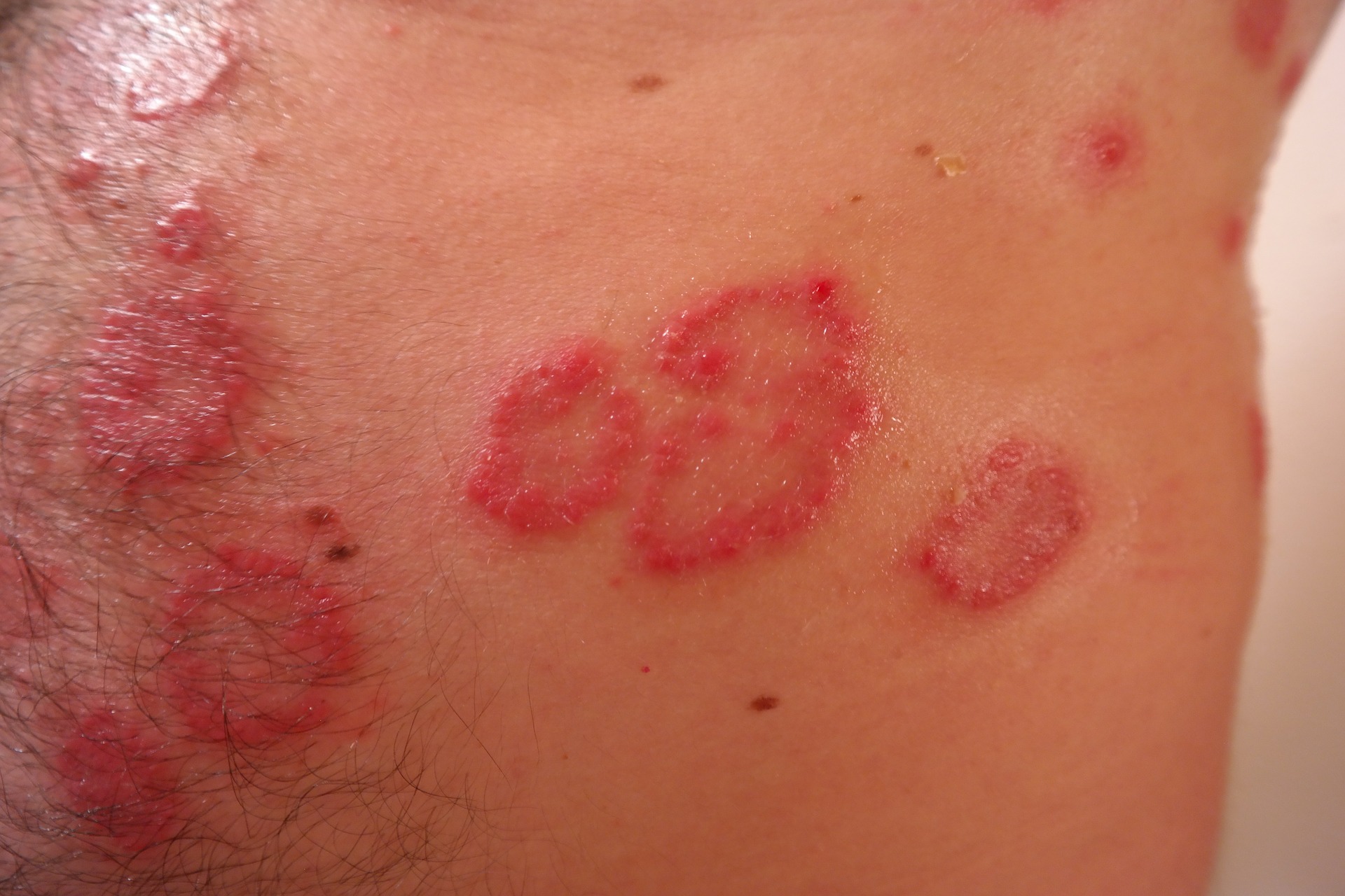 psoriazė ant kūno